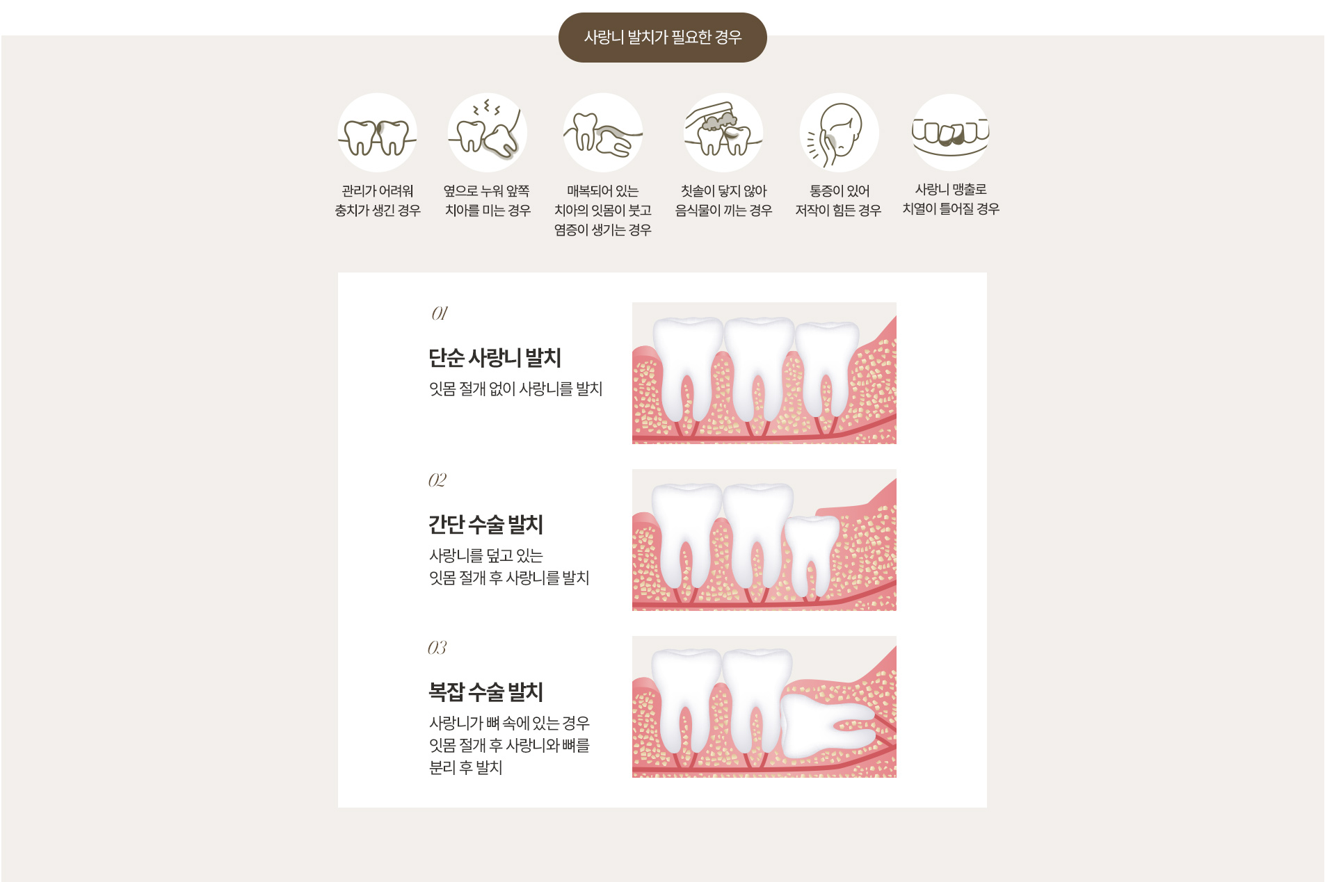사랑니 발치 종류