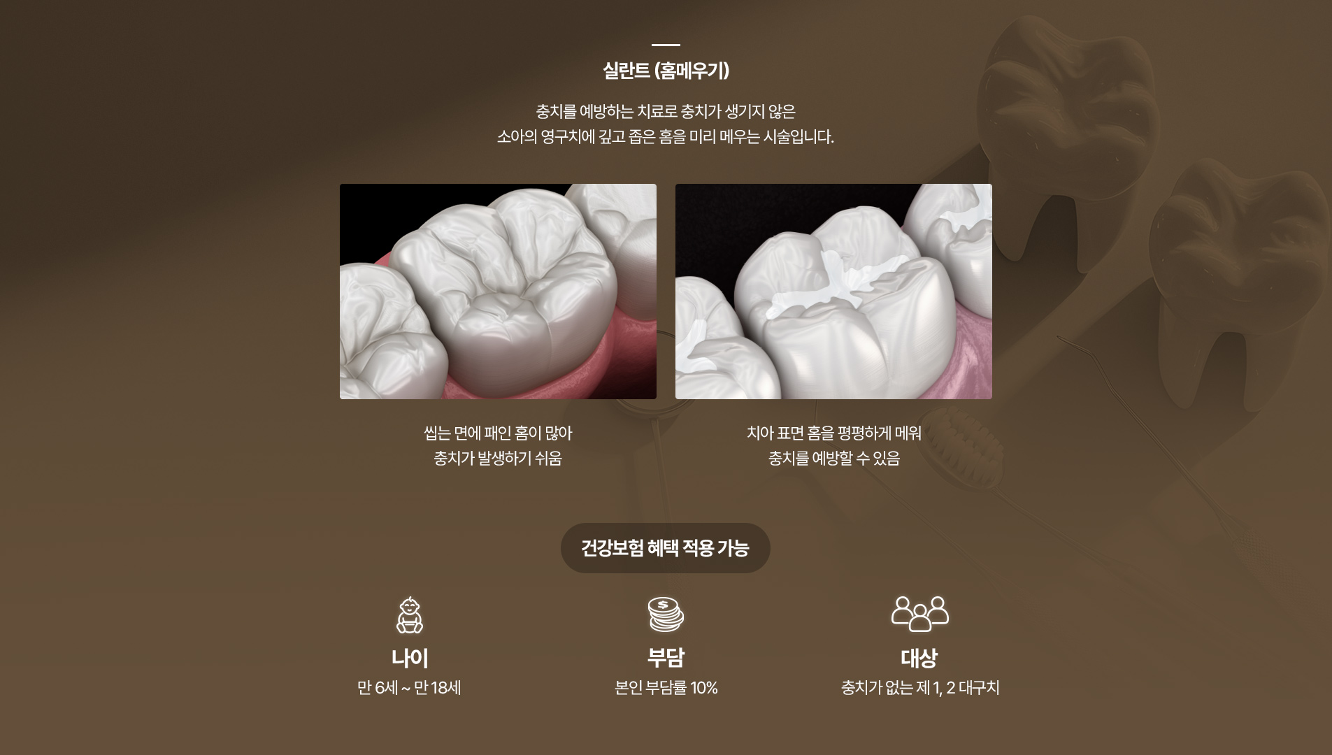 우리아이 첫 치과 - 실란트(홈메우기)