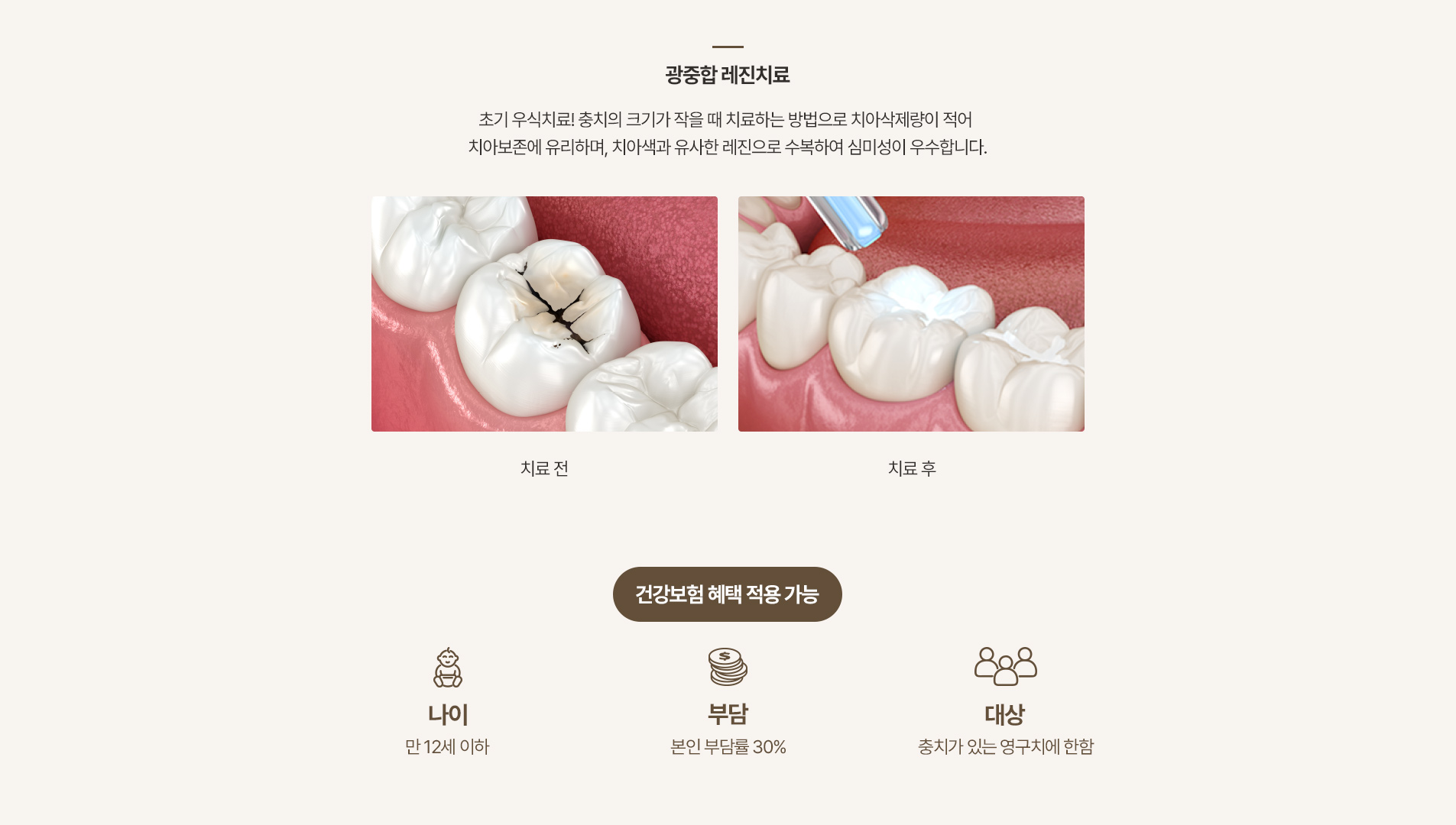 우리아이 첫 치과 - 광중합 레진치료