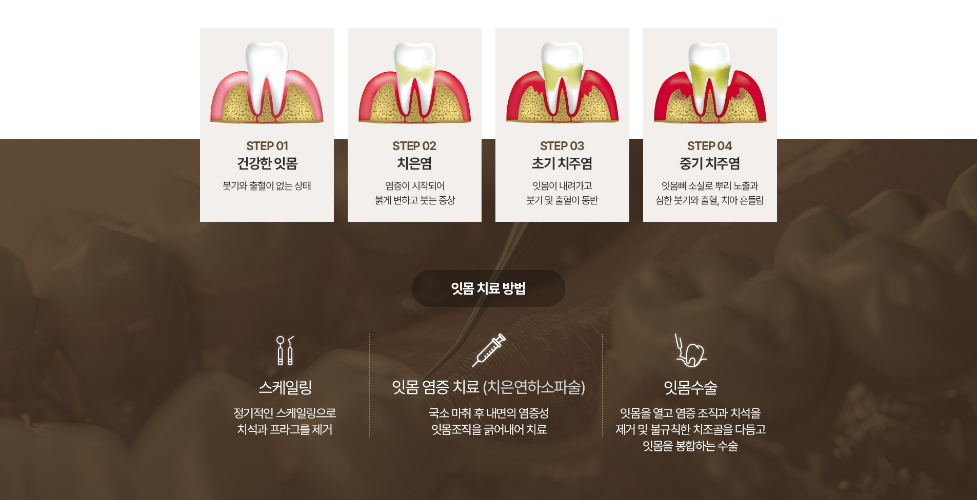 잇몸병 진행 과정과 잇몸 치료 방법