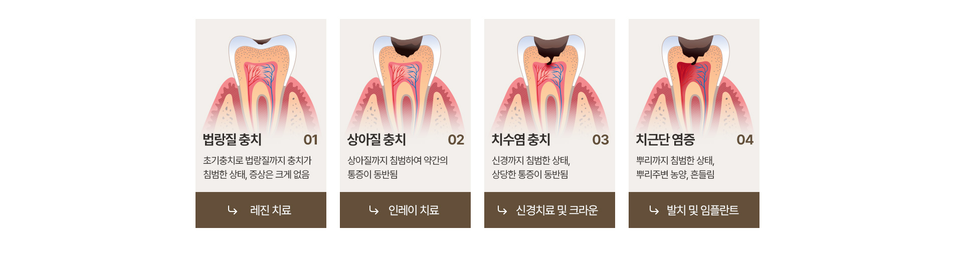 충치 진행 과정과 과정별 치료